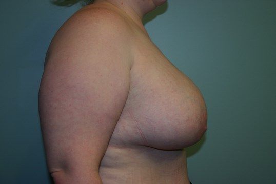 Breast Augmentation Before & After