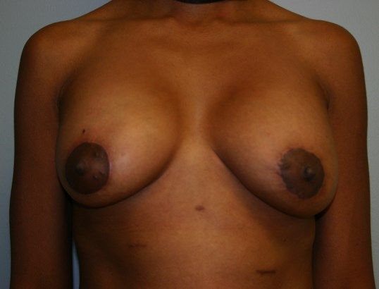 Breast Augmentation Before & After