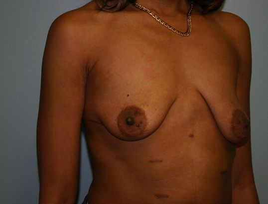 Breast Augmentation Before & After