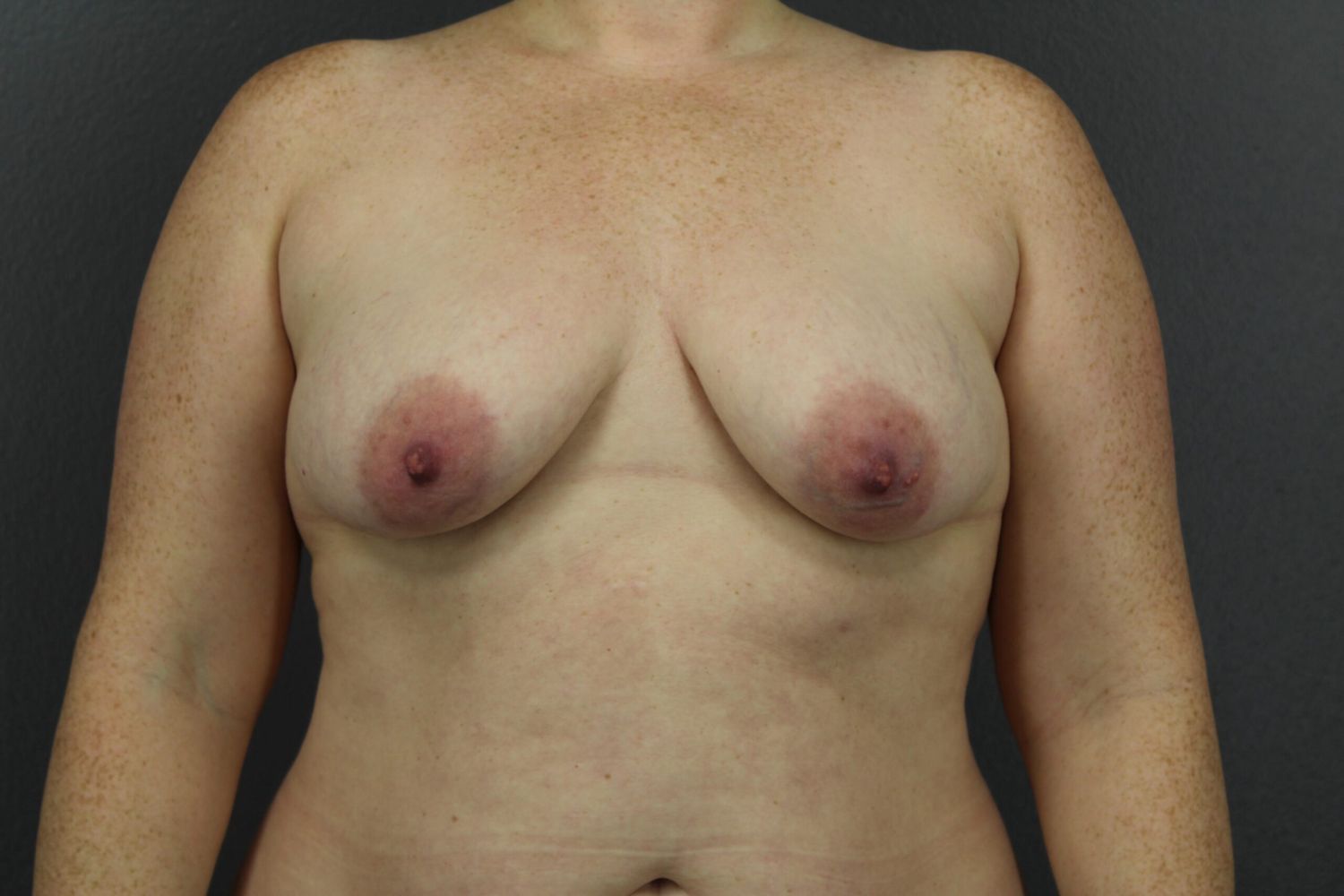 Breast Augmentation Before & After