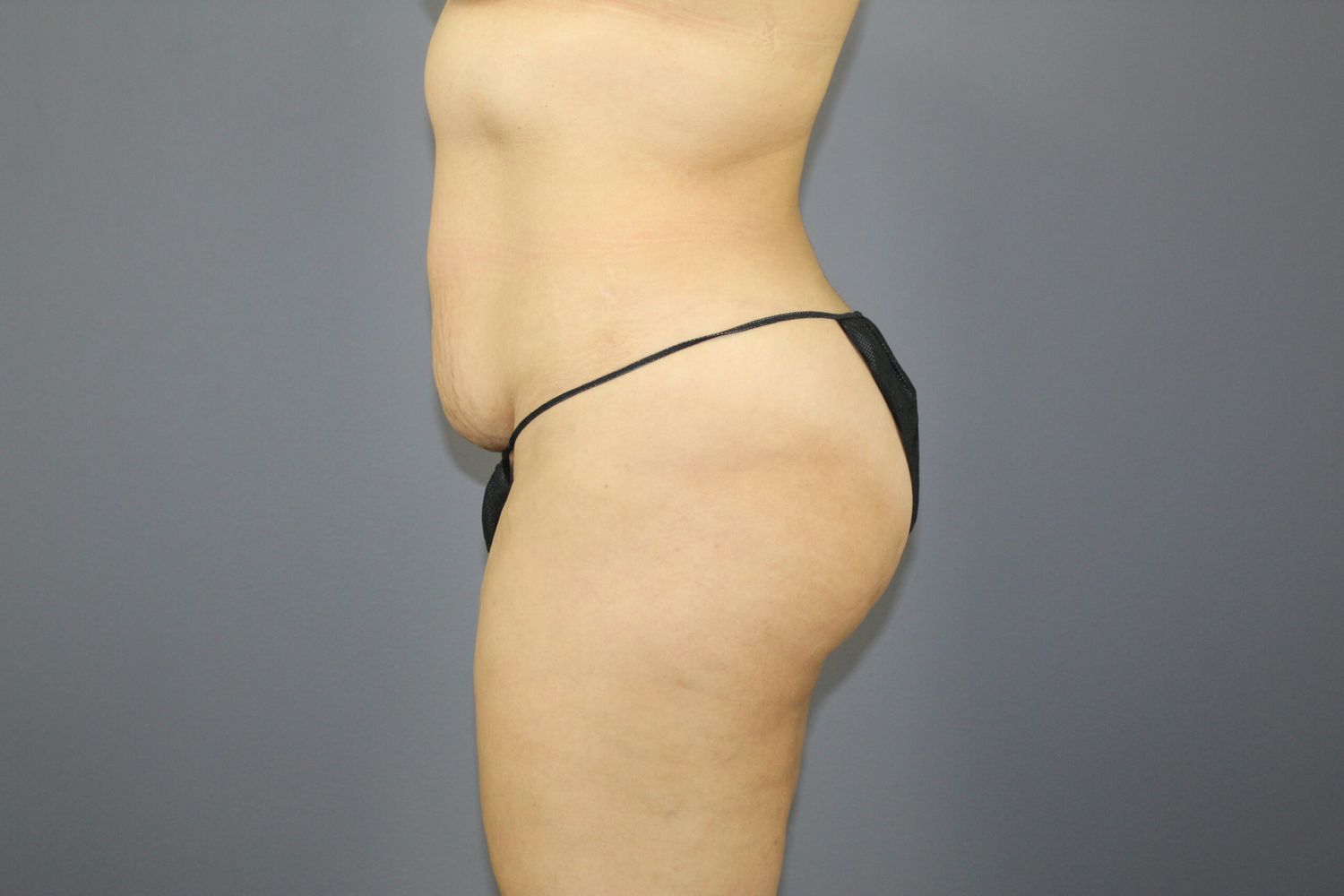 Tummy Tuck Before & After