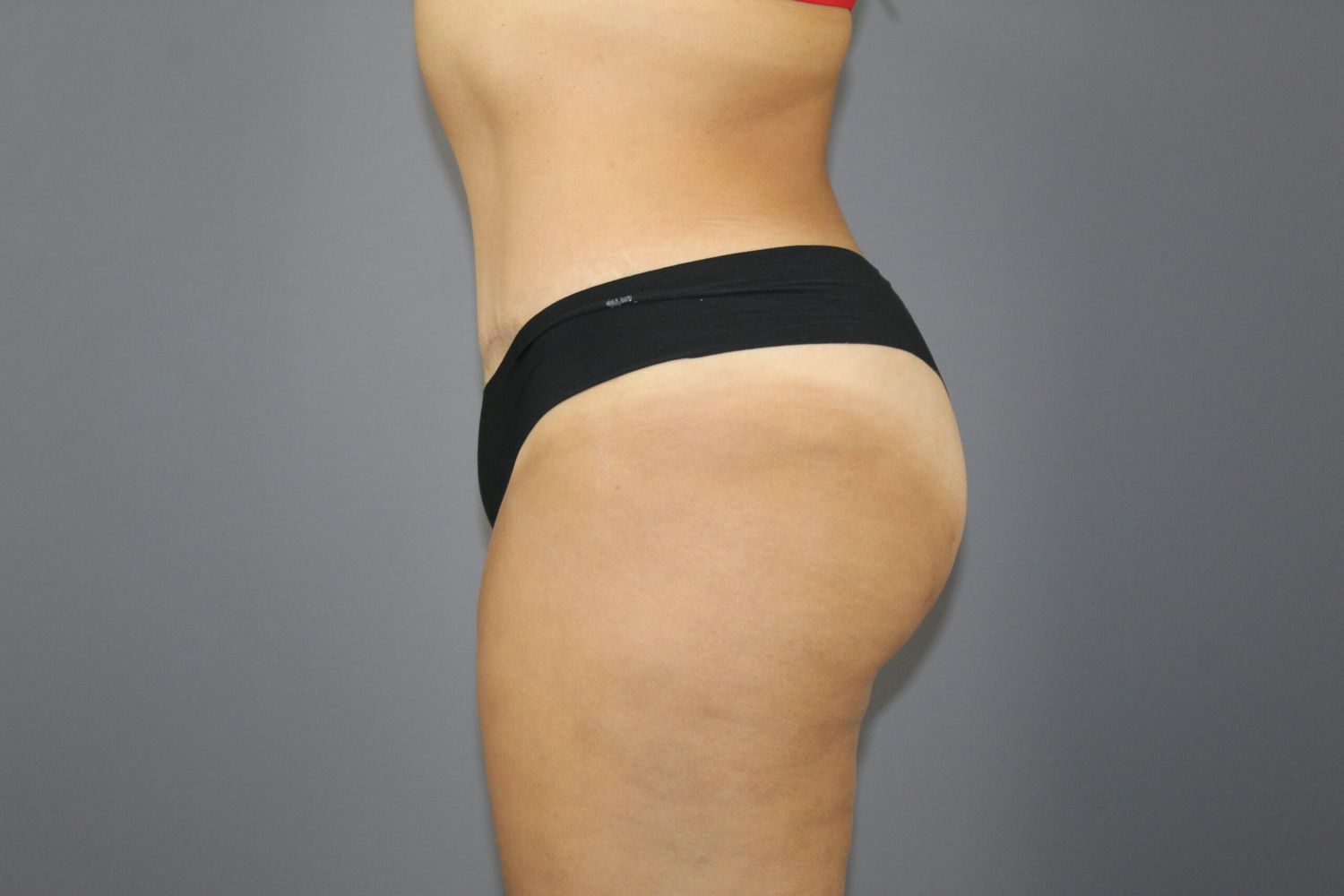 Tummy Tuck Before & After