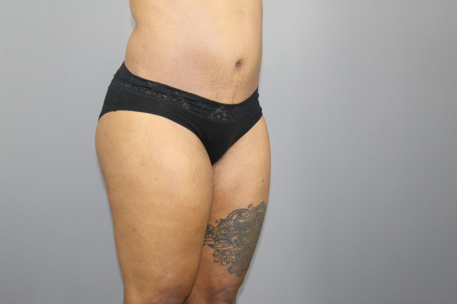 Tummy Tuck Before & After