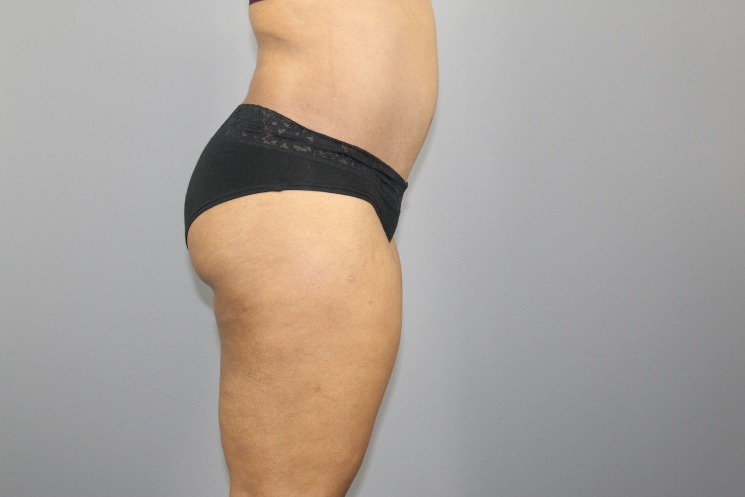 Tummy Tuck Before & After