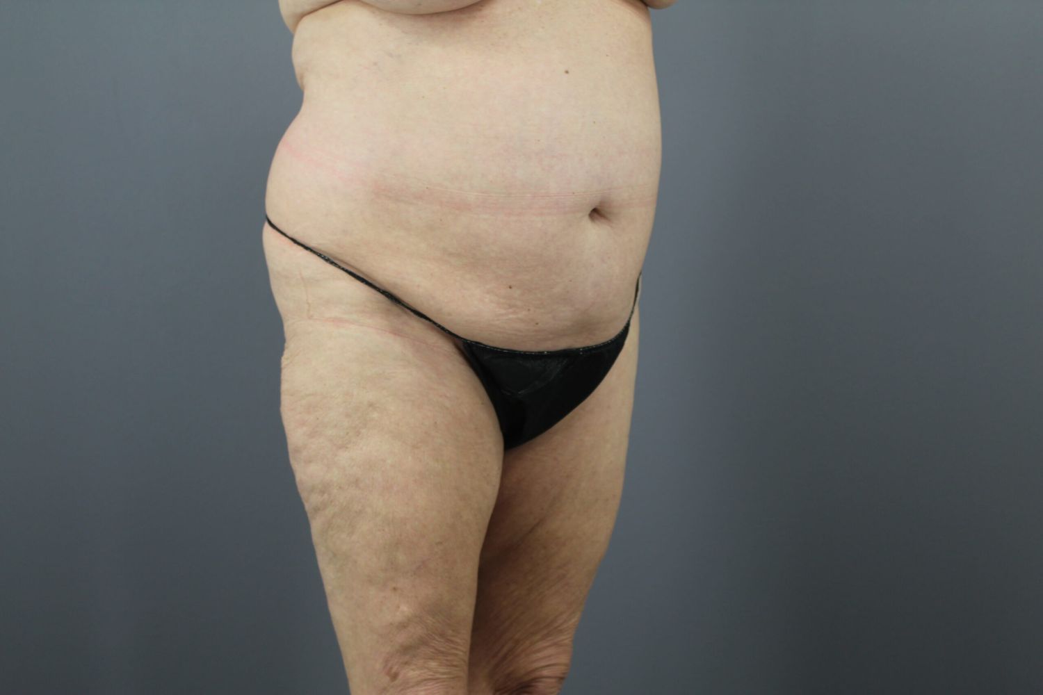 Tummy Tuck Before & After