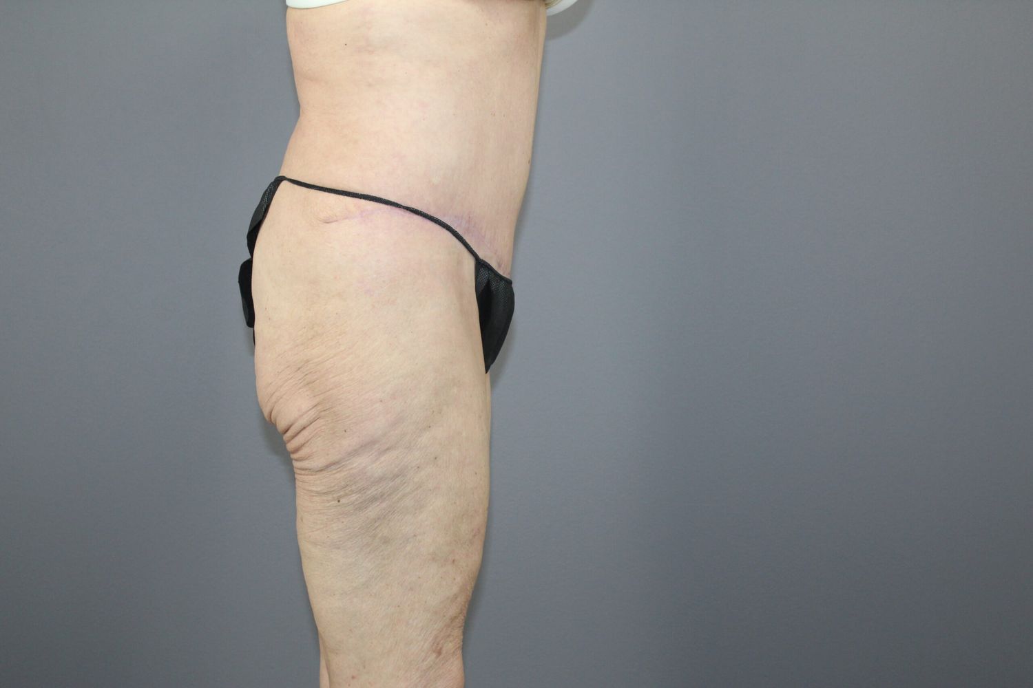 Tummy Tuck Before & After