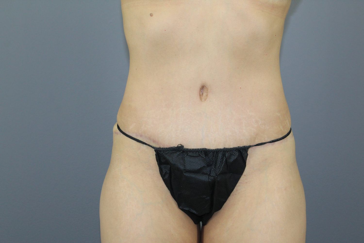 Tummy Tuck Before & After