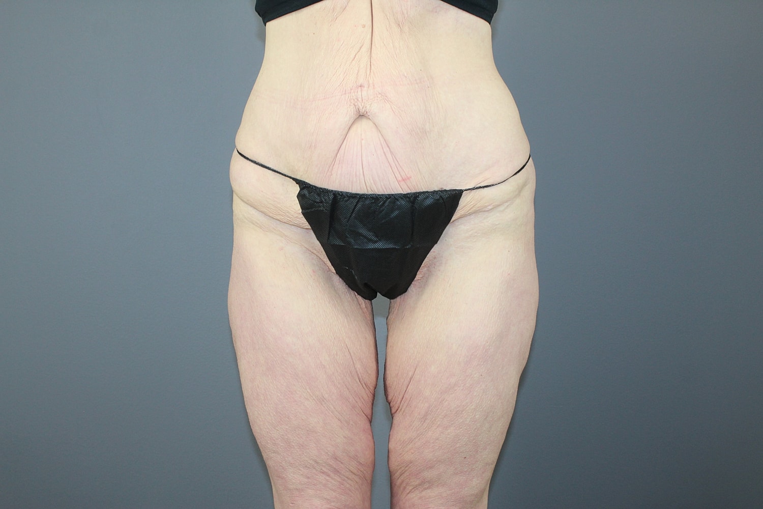 Tummy Tuck Before & After
