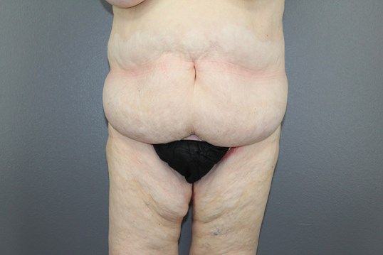 Tummy Tuck Before & After