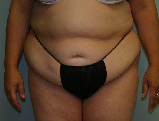 Tummy Tuck Before & After