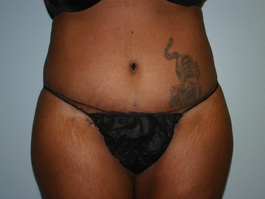 Tummy Tuck Before & After