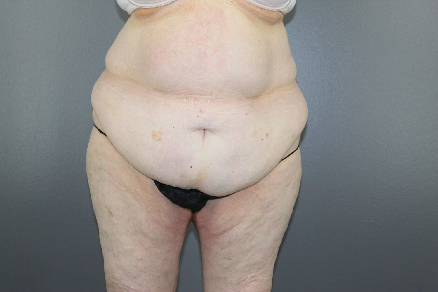 Tummy Tuck Before & After