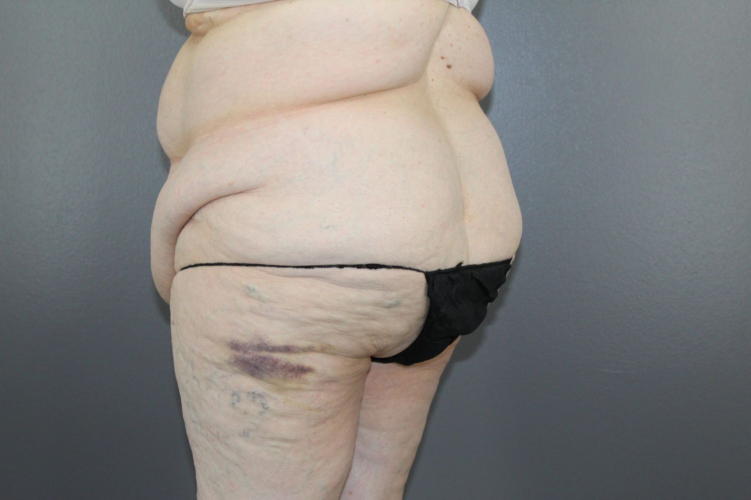 Tummy Tuck Before & After