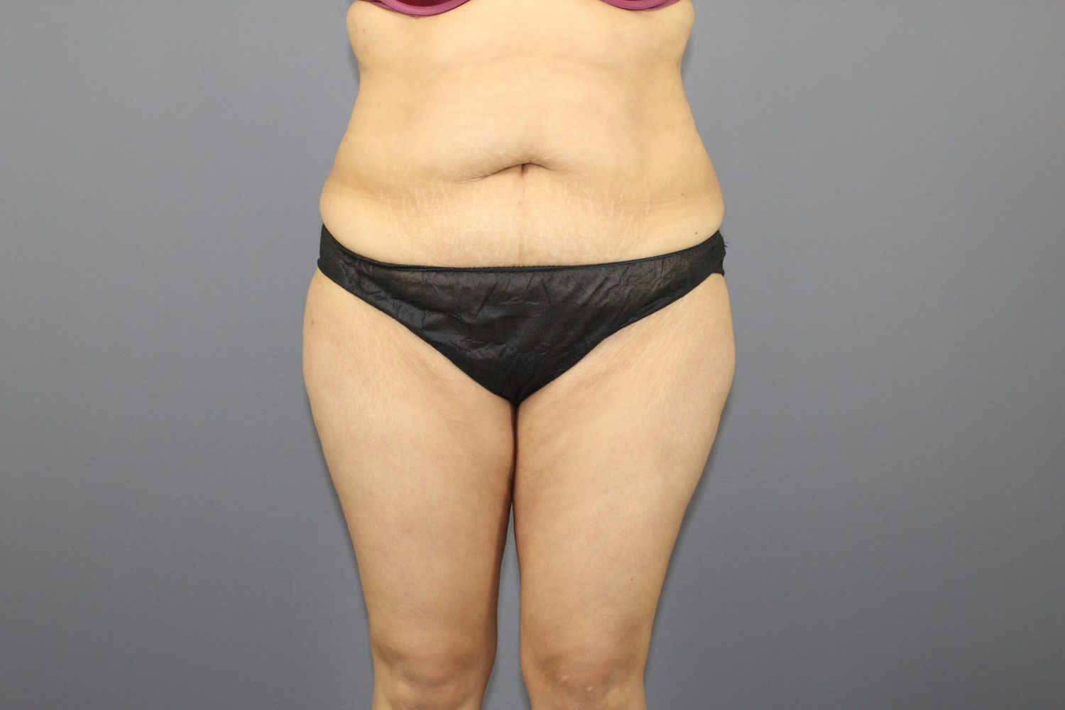 Tummy Tuck Before & After