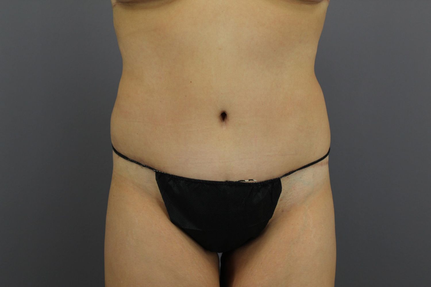 Tummy Tuck Before & After