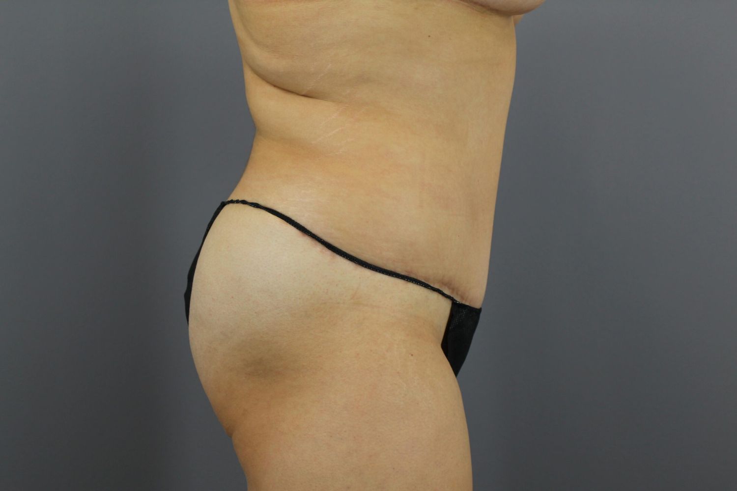 Tummy Tuck Before & After