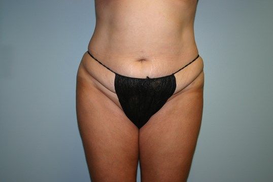Tummy Tuck Before & After
