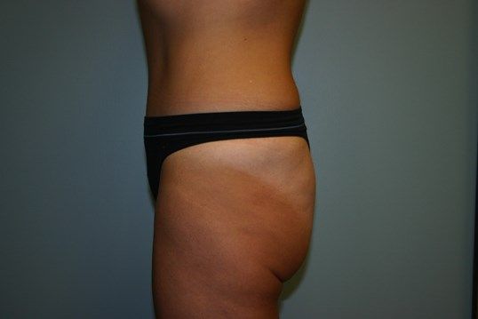 Tummy Tuck Before & After