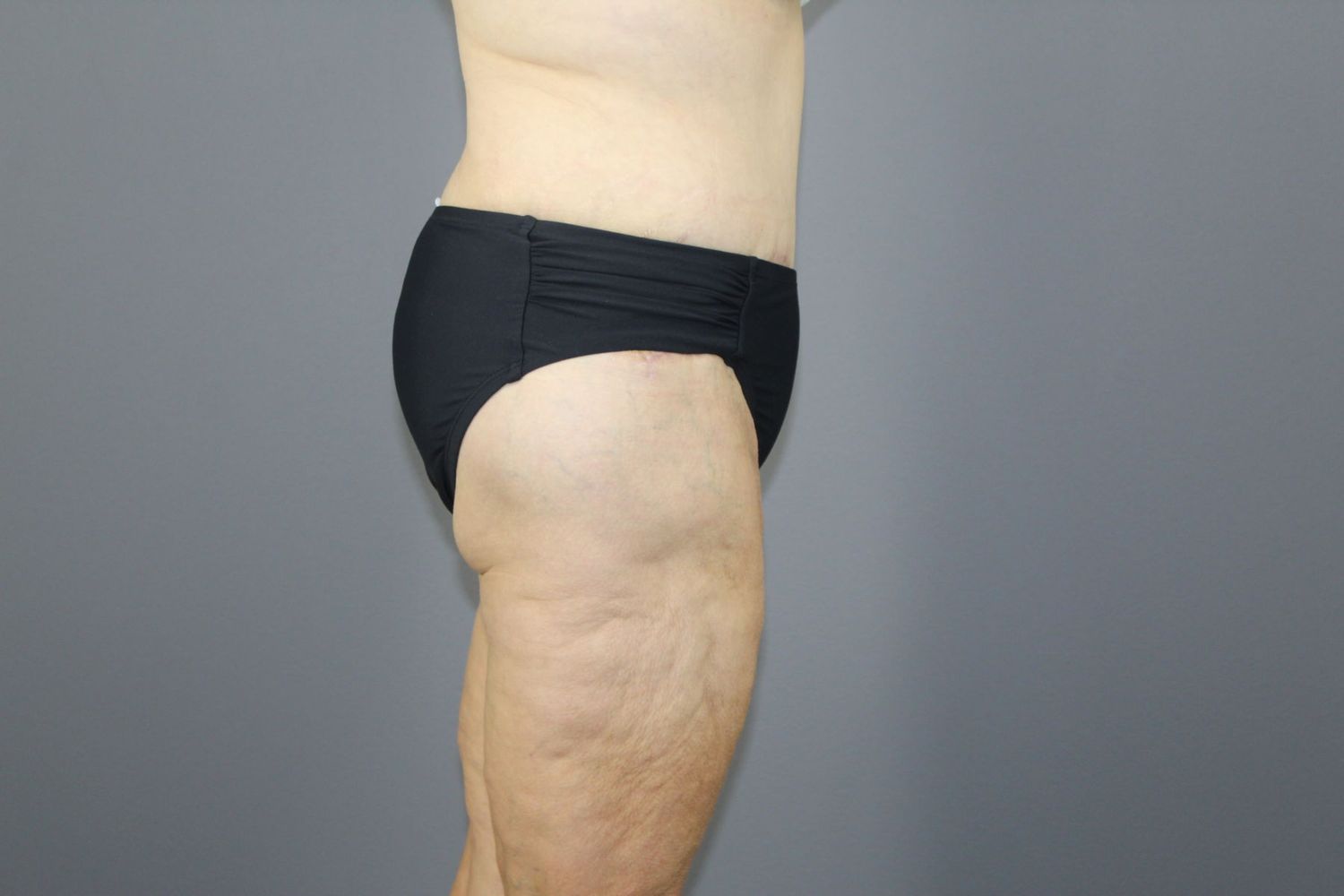 Tummy Tuck Before & After