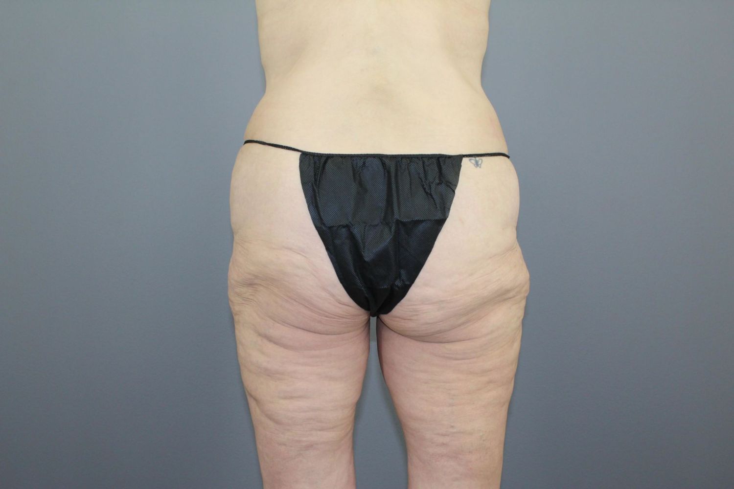 Tummy Tuck Before & After