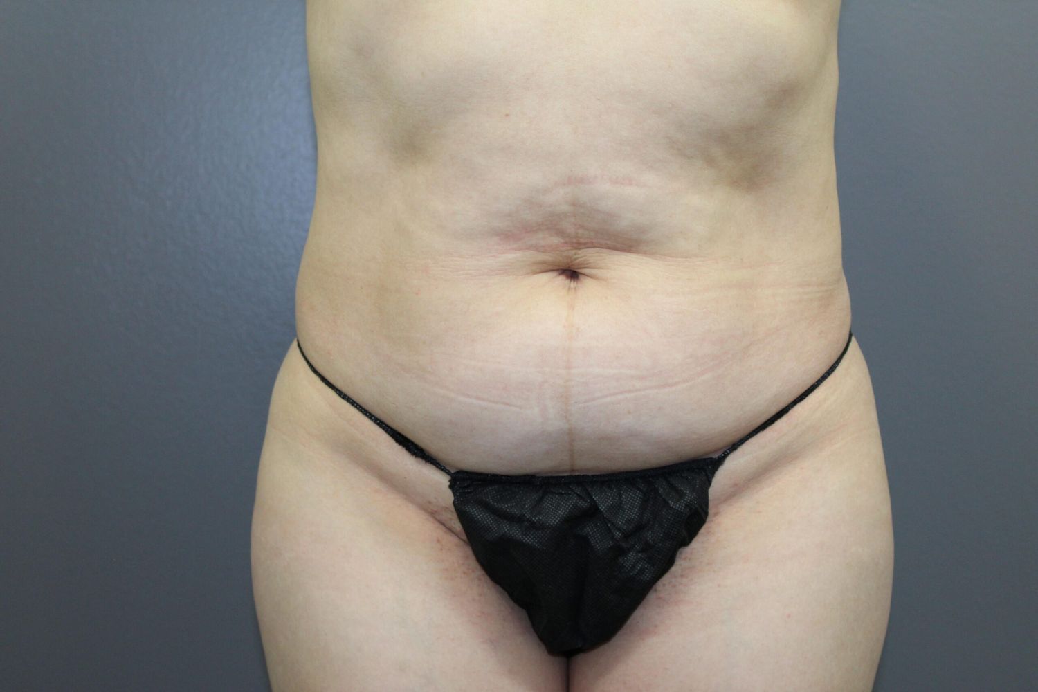 Tummy Tuck Before & After