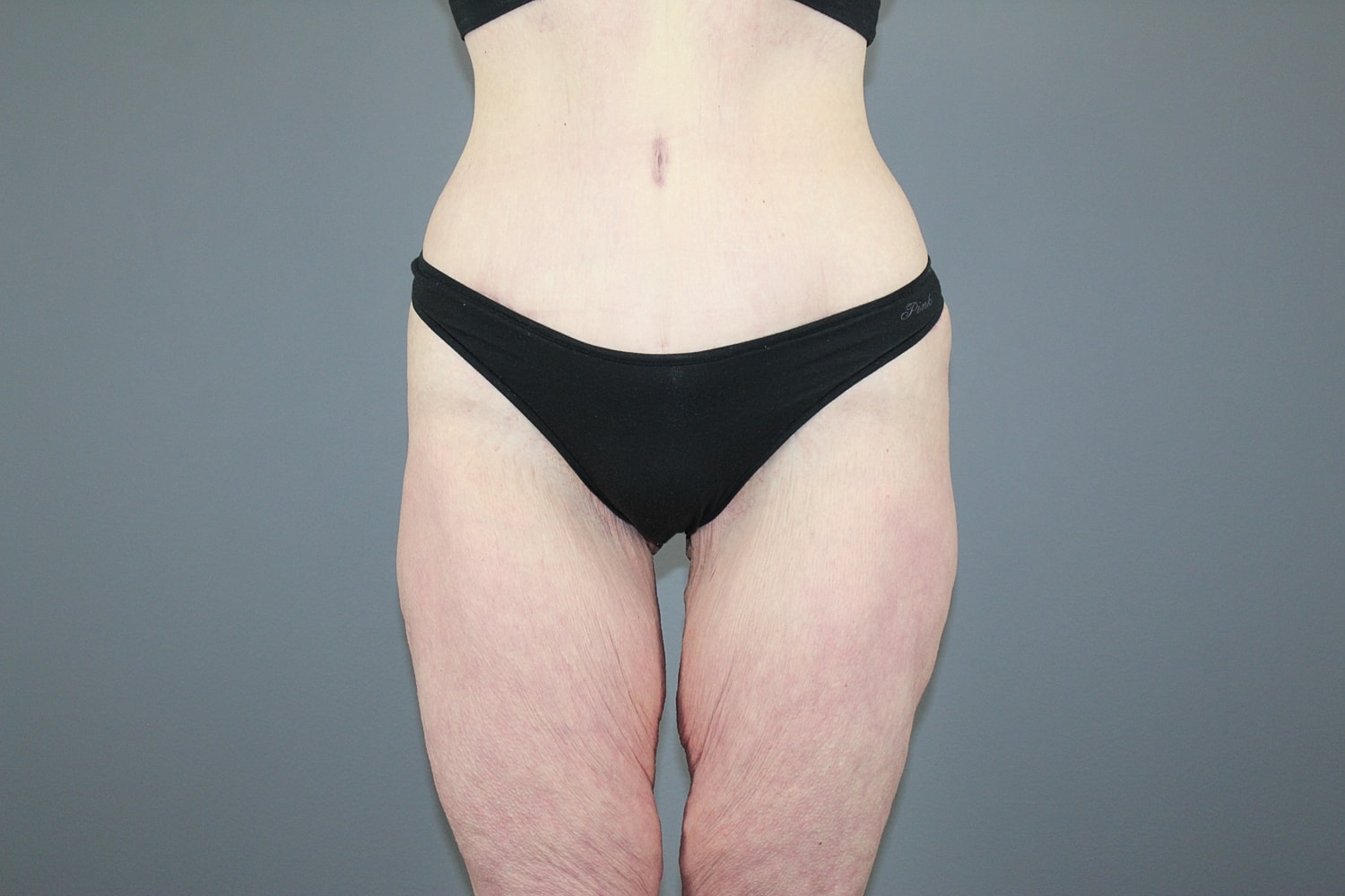 Tummy Tuck Before & After