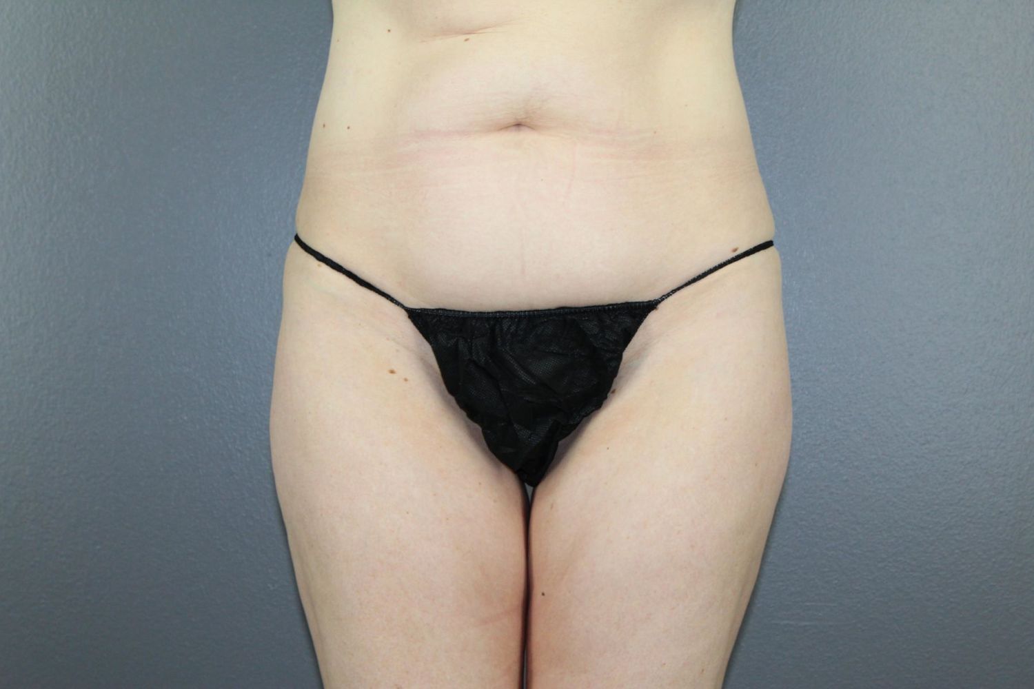 Tummy Tuck Before & After