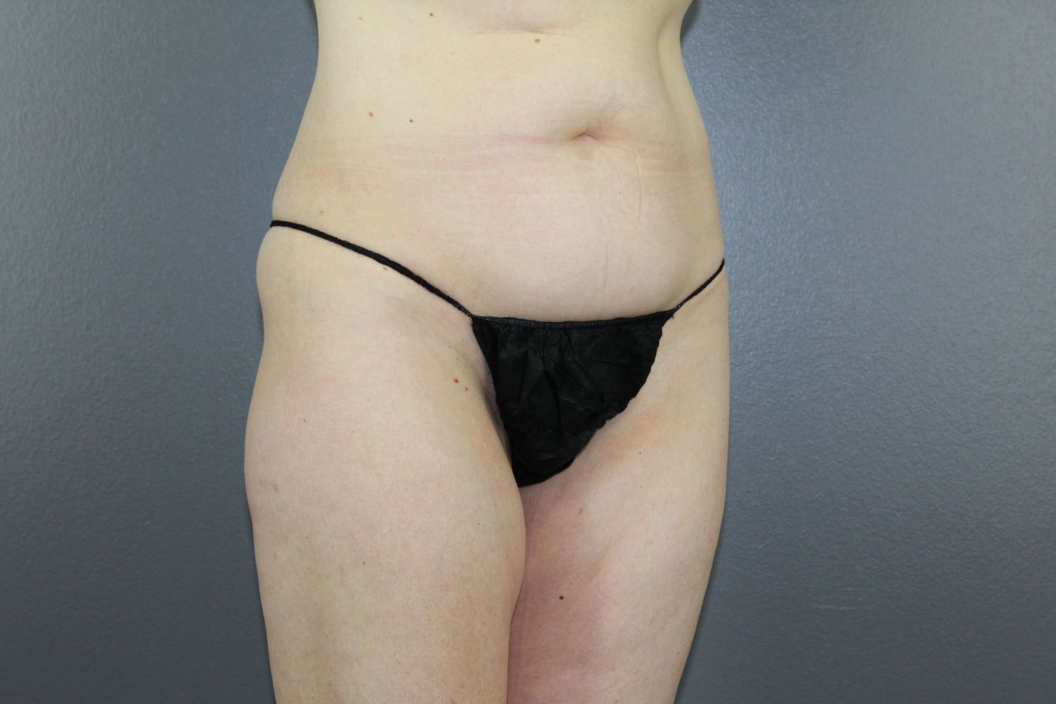 Tummy Tuck Before & After