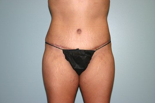 Tummy Tuck Before & After