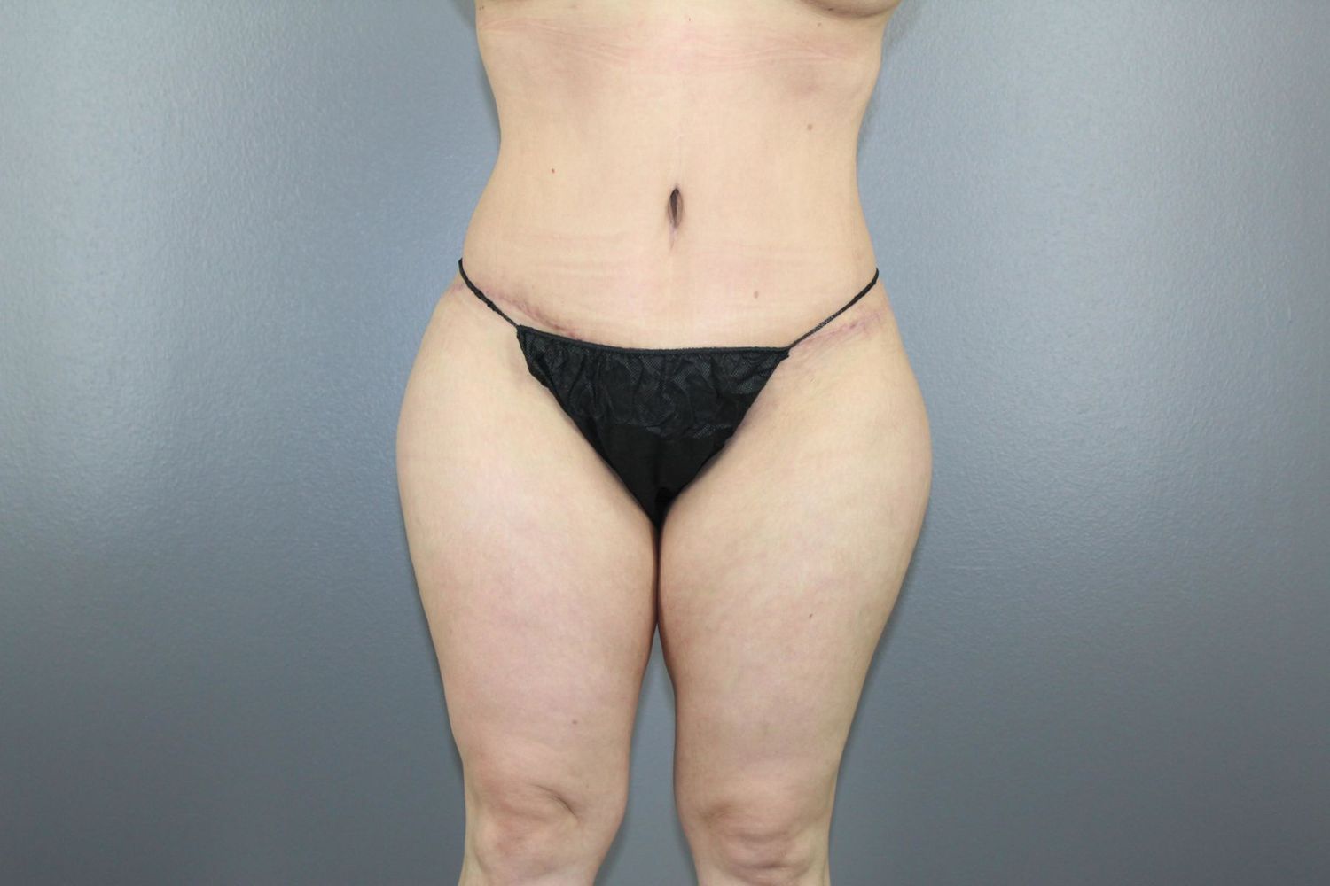 Tummy Tuck Before & After