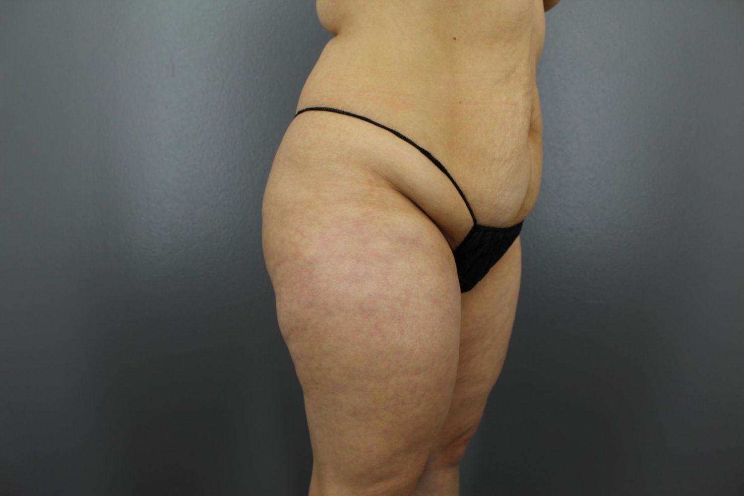 Tummy Tuck Before & After