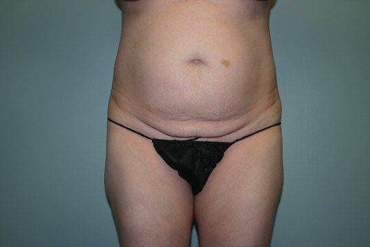 Tummy Tuck Before & After