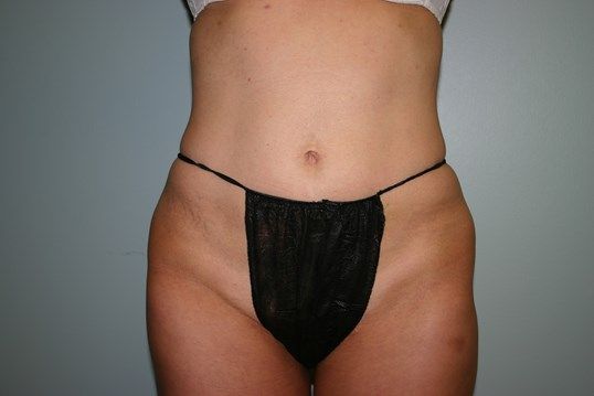 Tummy Tuck Before & After