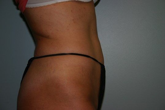 Tummy Tuck Before & After