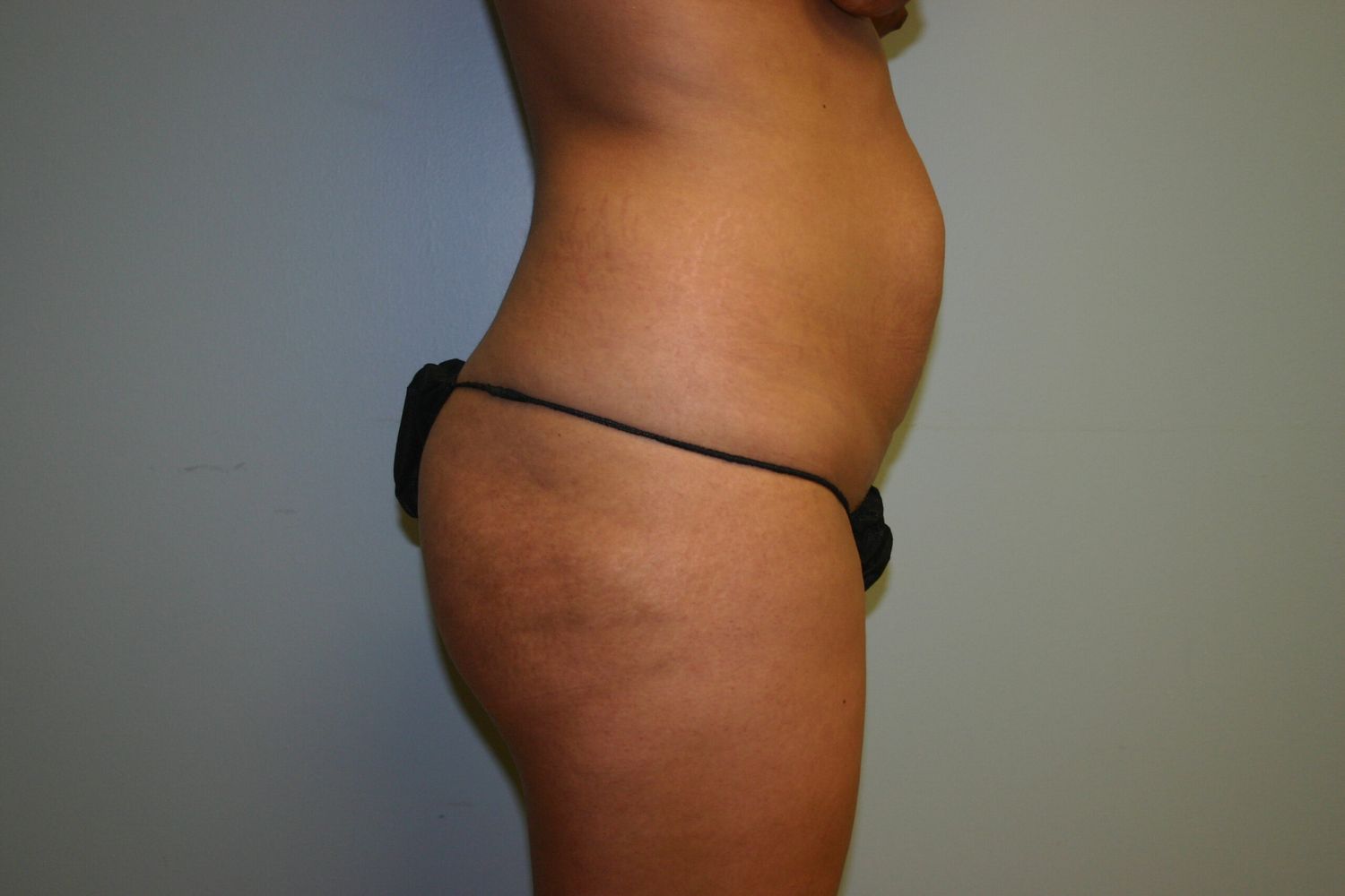 Tummy Tuck Before & After