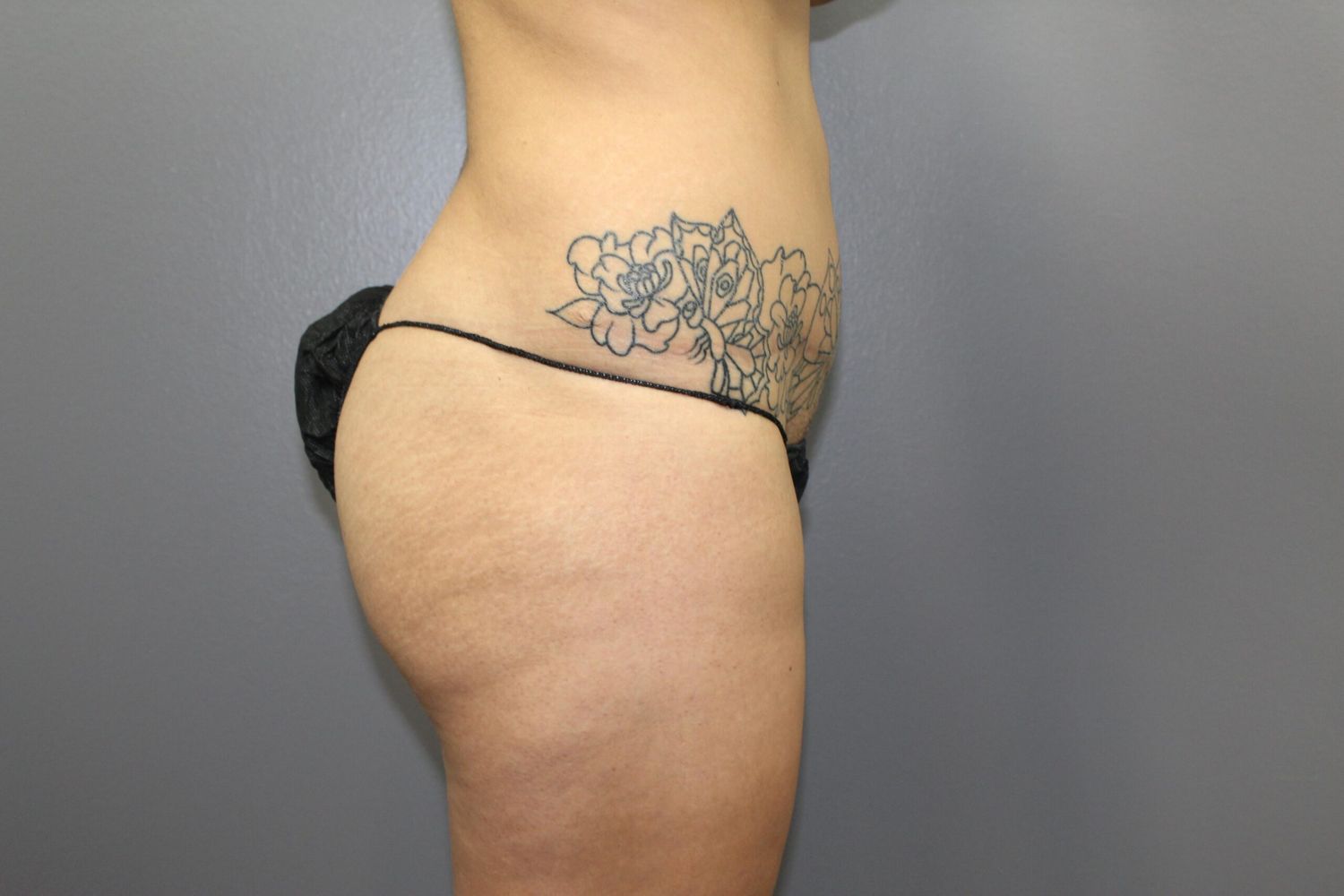Tummy Tuck Before & After