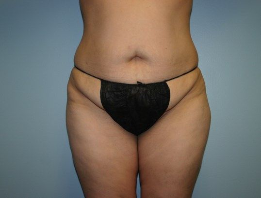 Tummy Tuck Before & After