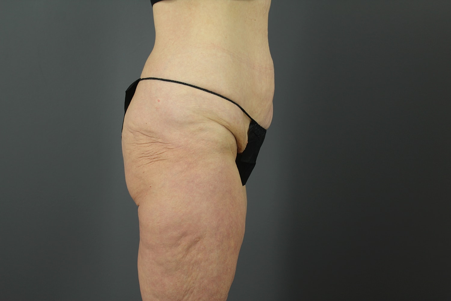 Tummy Tuck Before & After