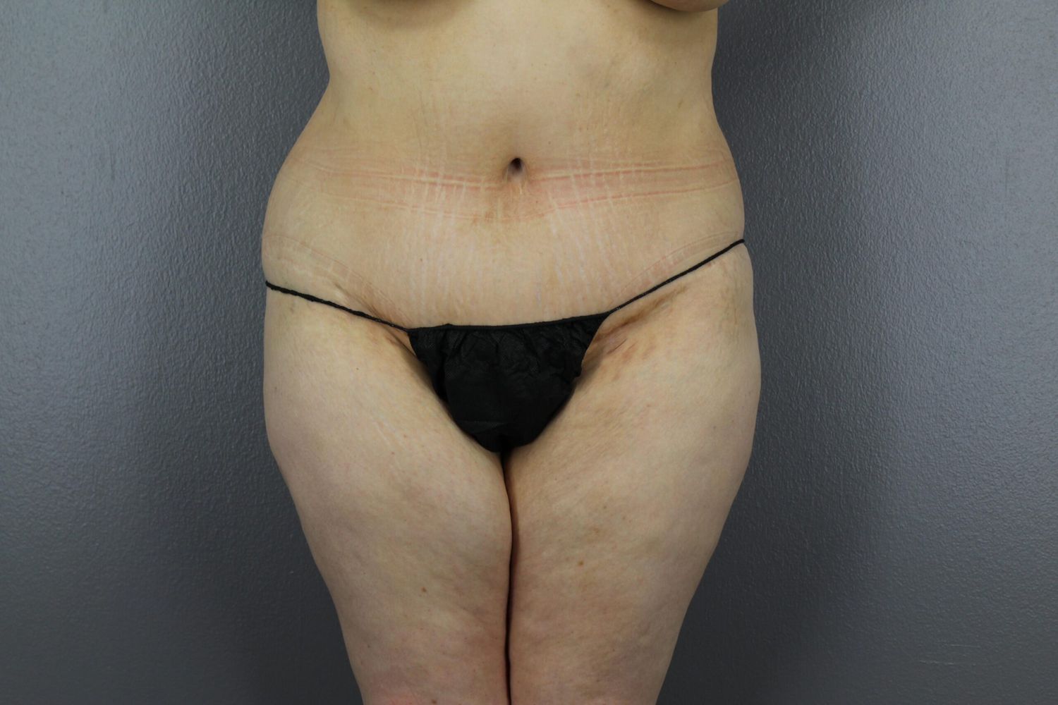 Tummy Tuck Before & After