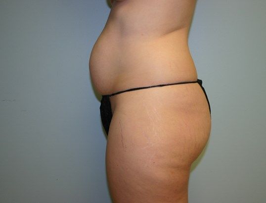 Tummy Tuck Before & After