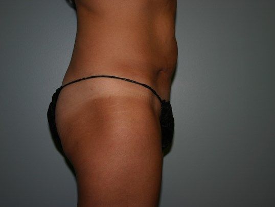 Tummy Tuck Before & After