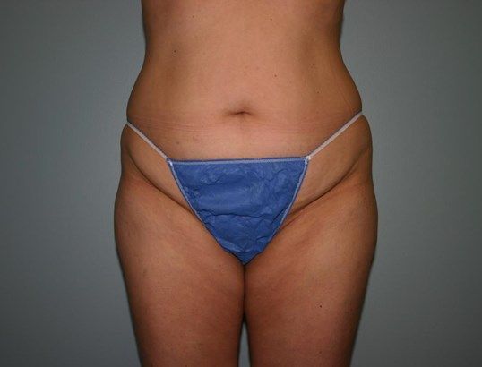 Tummy Tuck Before & After