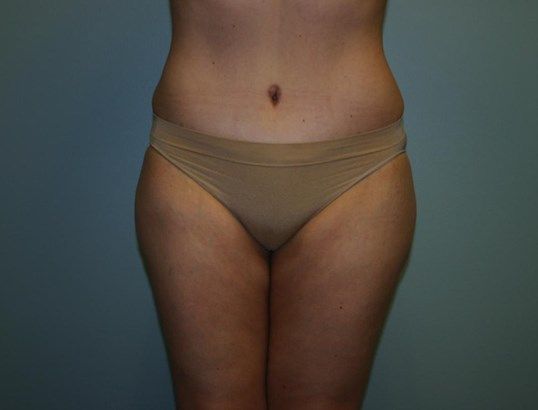 Tummy Tuck Before & After