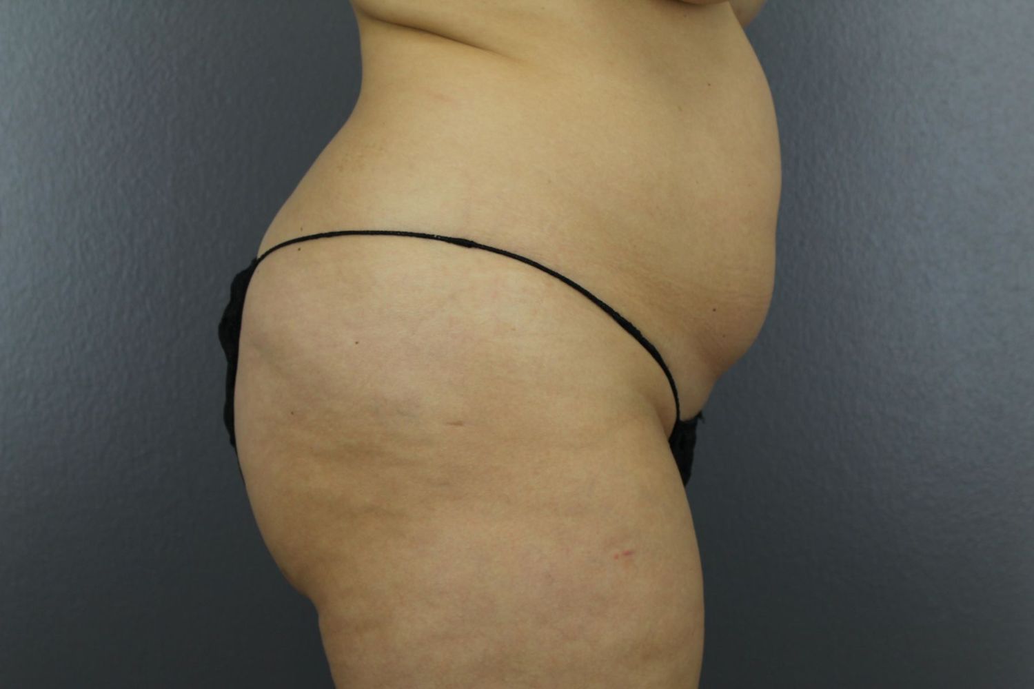 Tummy Tuck Before & After