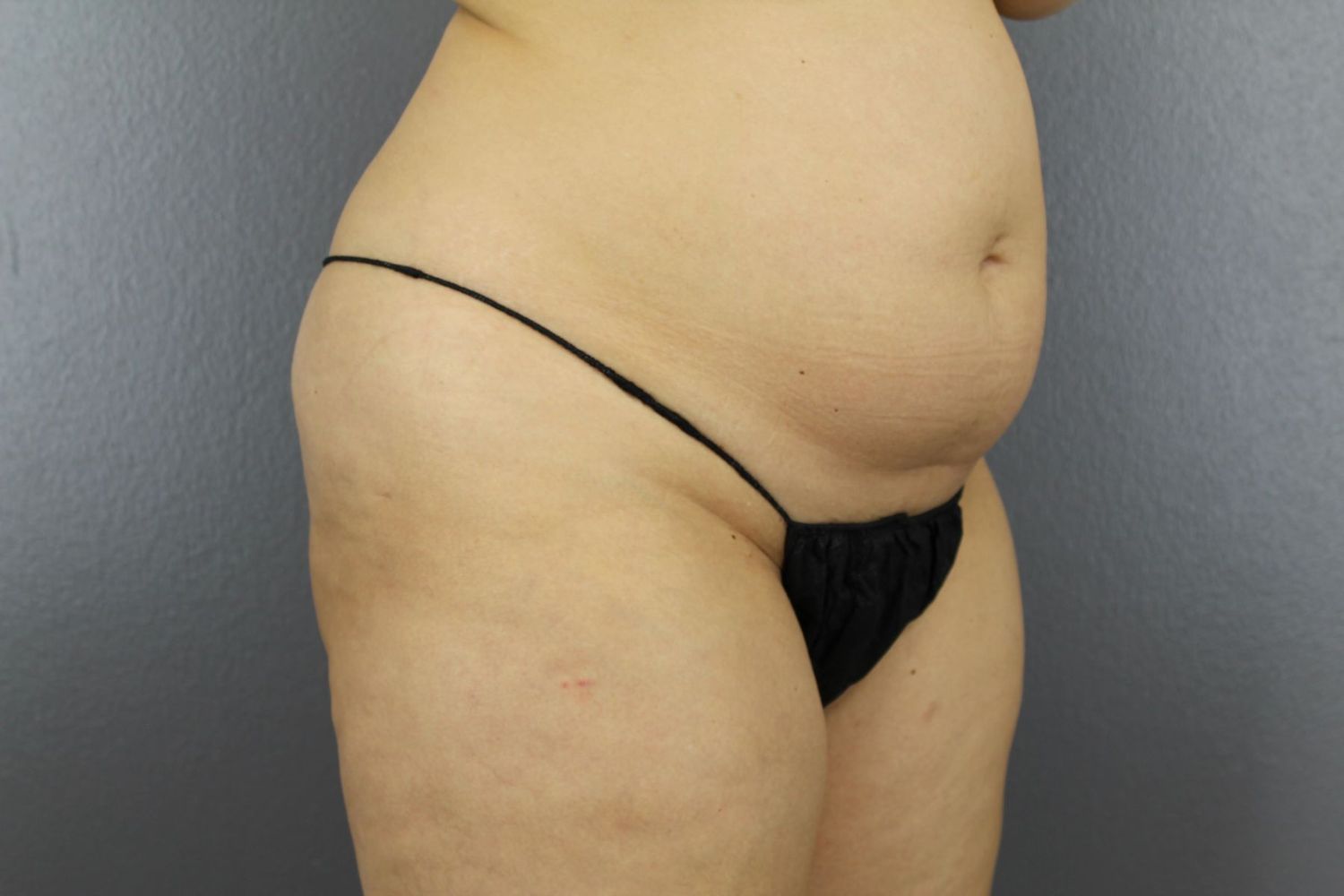 Tummy Tuck Before & After