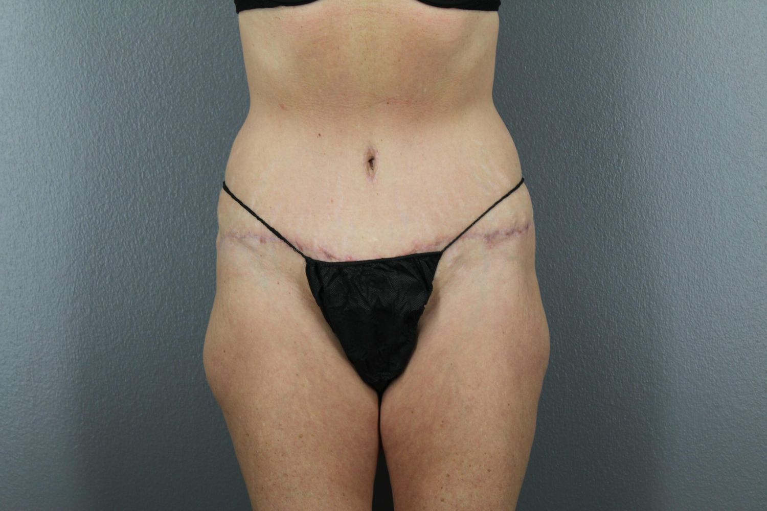 Tummy Tuck Before & After