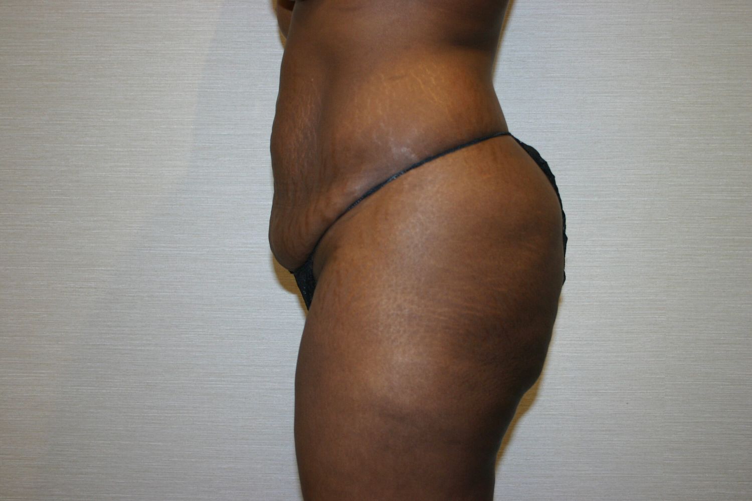 Tummy Tuck Before & After