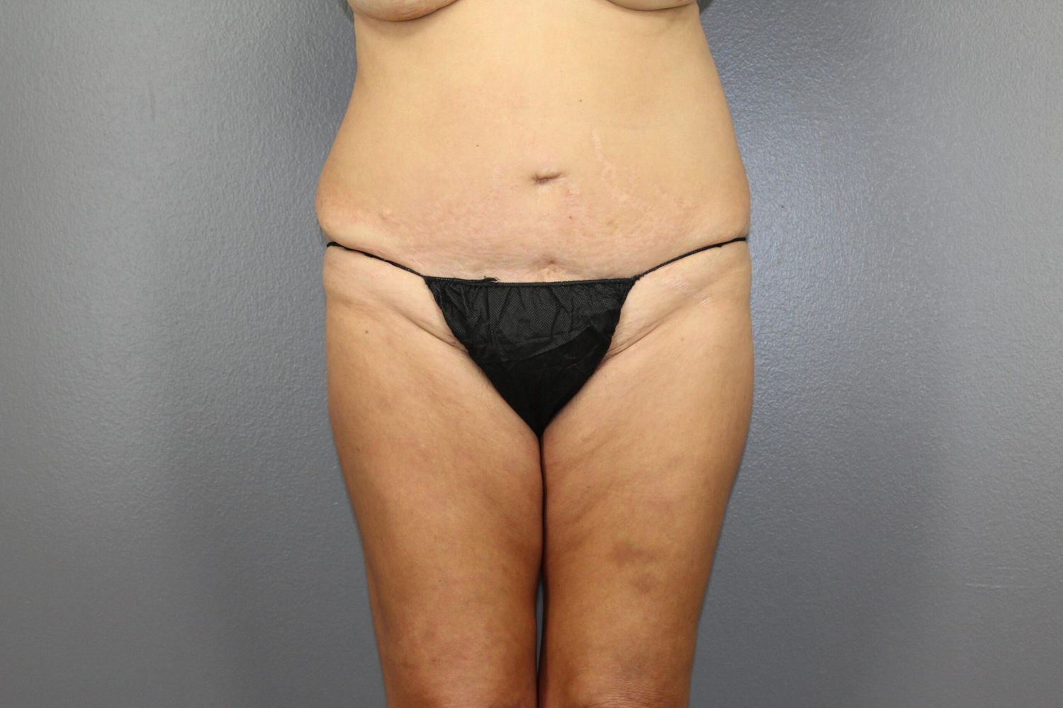 Tummy Tuck Before & After