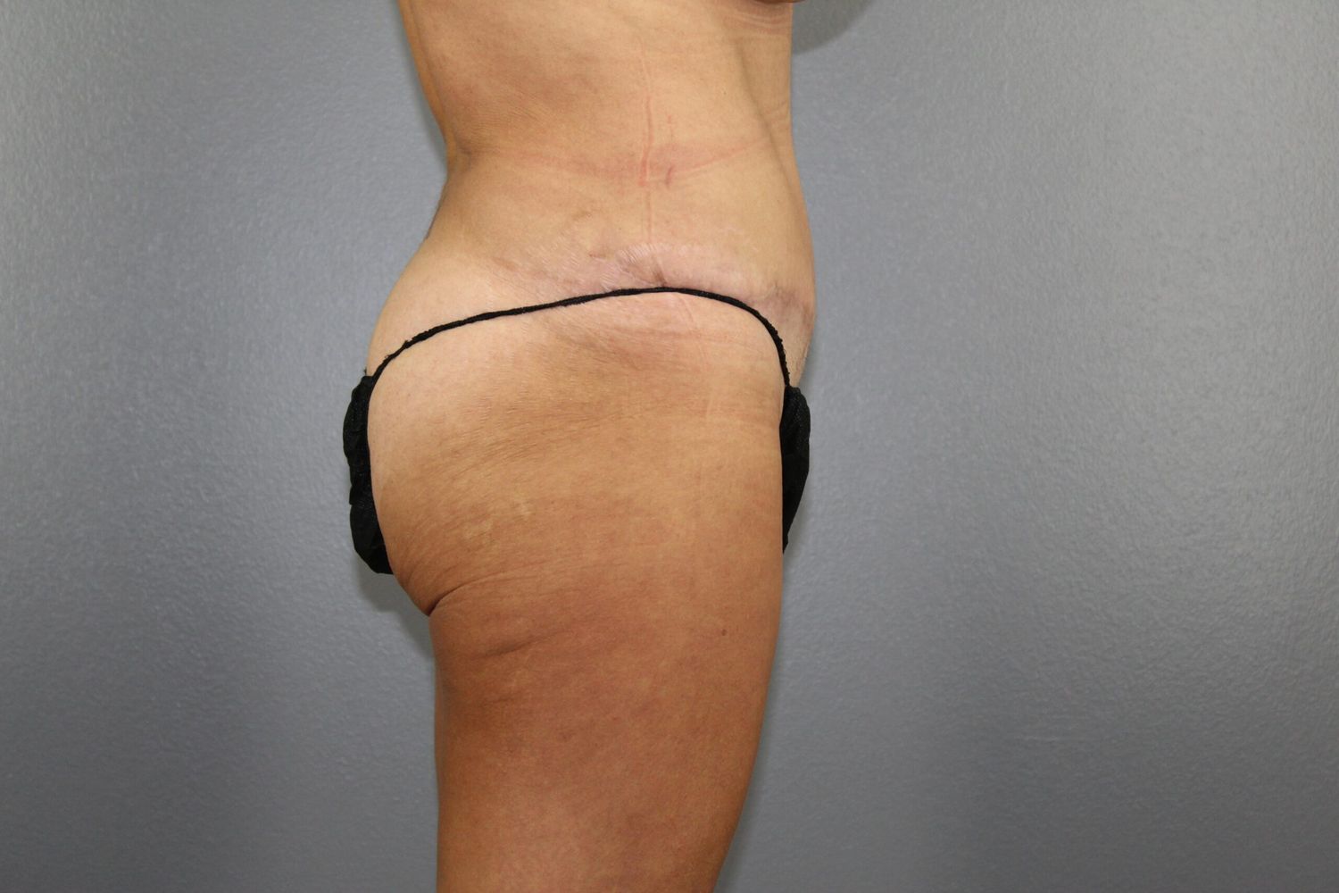 Tummy Tuck Before & After
