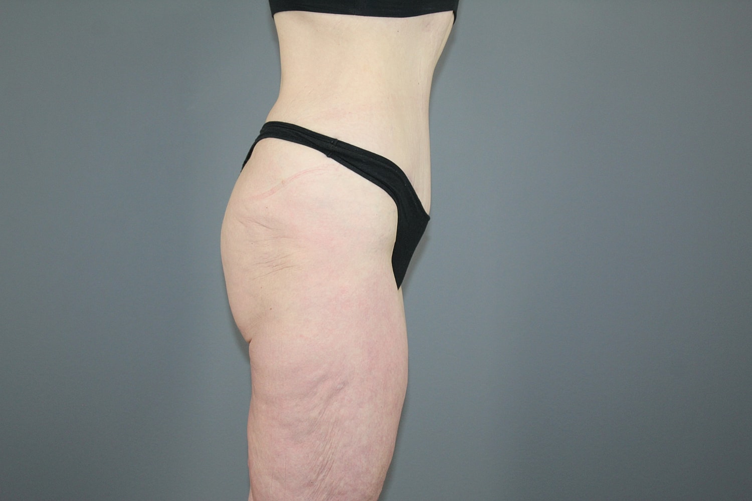 Tummy Tuck Before & After